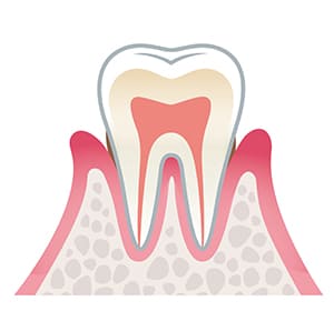 軽度の歯周病(歯肉炎)