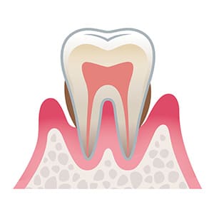 中等度の歯周病