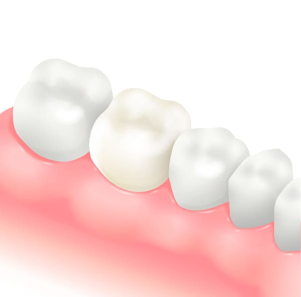 セラミック治療(詰め物・被せ物)