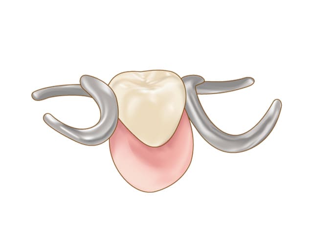 部分入れ歯