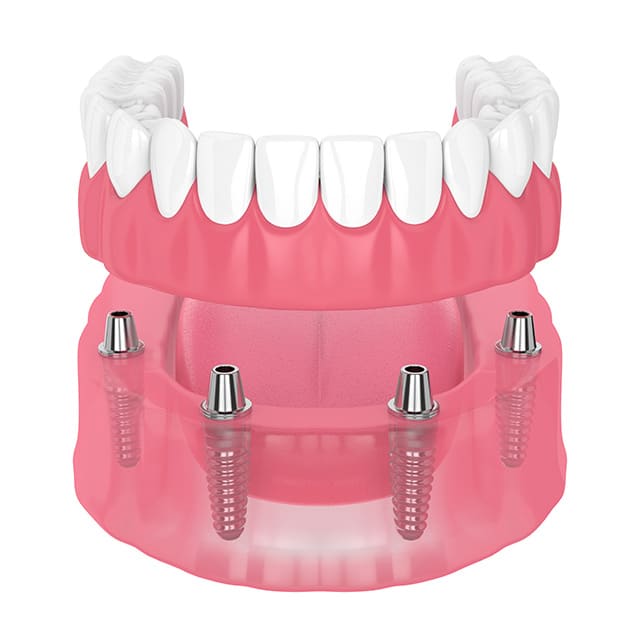 インプラントオーバーデンチャー（自費）