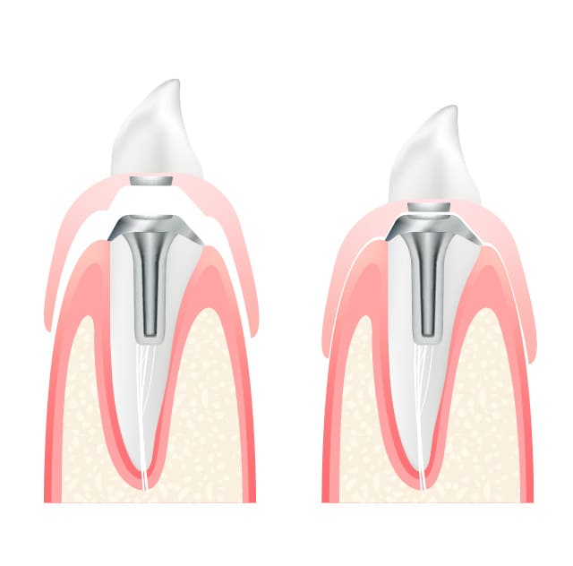 マグネットデンチャー（自費）