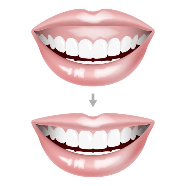 ガミースマイル治療