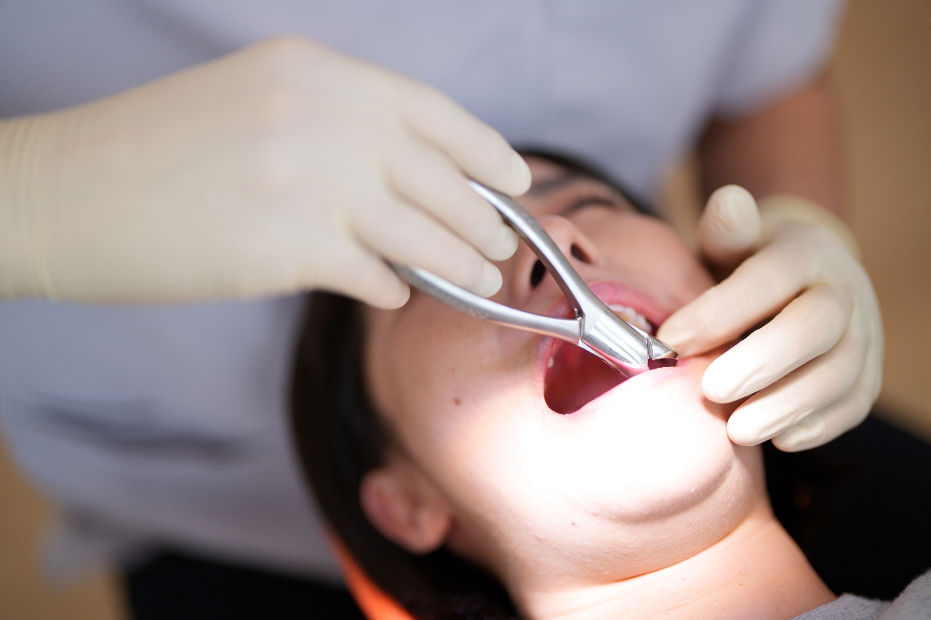 抜歯後の穴はいつ塞がる？完治までの期間と正しいケア方法について解説