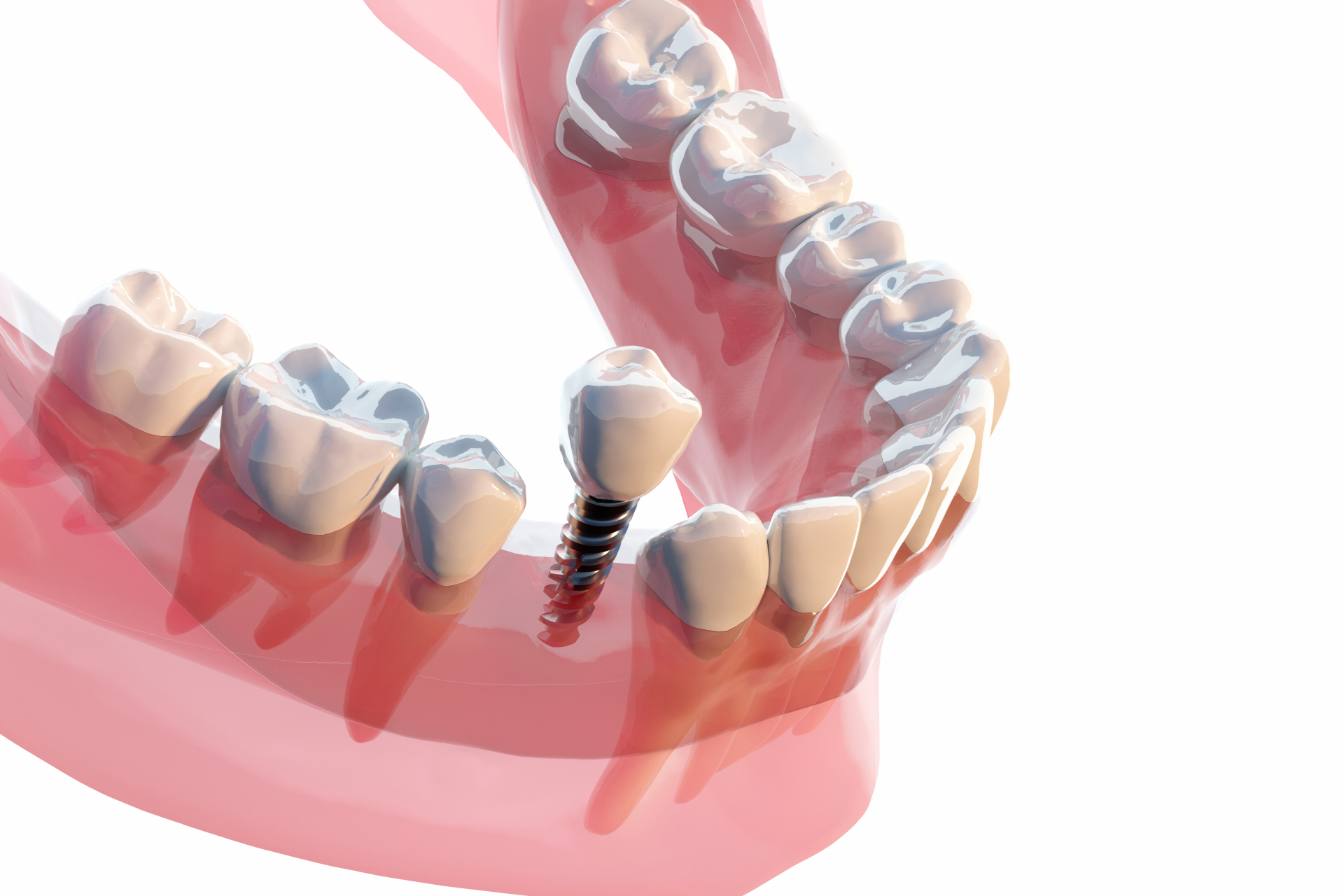 インプラント1本の相場はいくら？費用内訳や安く抑える方法を解説